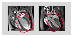 Low USP5 concentration leads to heart muscle weakness. The figure shows images of hearts using magnetic resonance imaging (MRI). While the heart of the control animal (right) is healthy in terms of size and thickness of the heart wall, a low USP5 concentration leads to dilatation of the heart and muscle weakness (dilated cardiomyopathy, left). Photo: MPI for Heart and Lung Research.